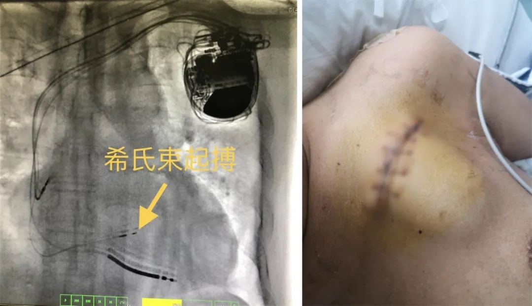 起搏器手术后疤痕图片图片